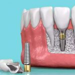 dental-implants11