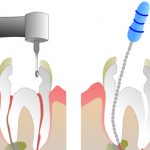 root-canal-page